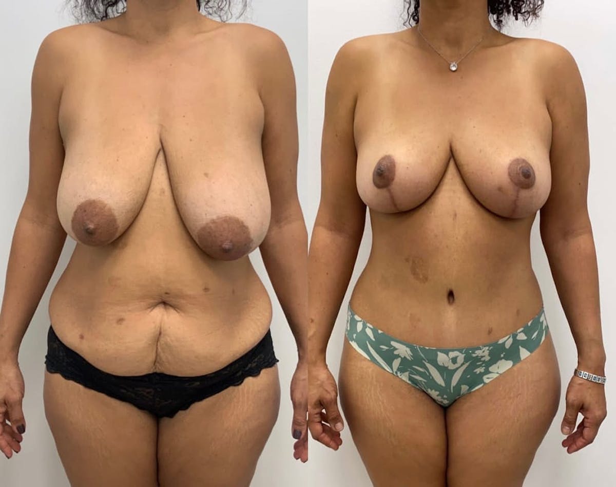 Tummy Tuck Before & After Gallery - Patient 427643 - Image 2