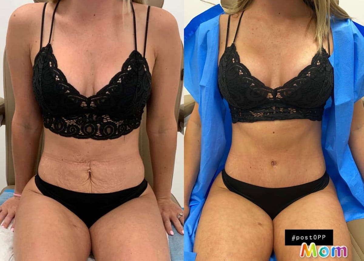 Tummy Tuck Before & After Gallery - Patient 389437 - Image 1