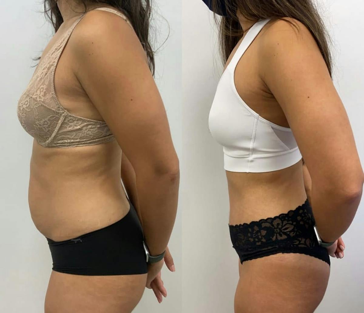 Tummy Tuck Before & After Gallery - Patient 204213 - Image 1
