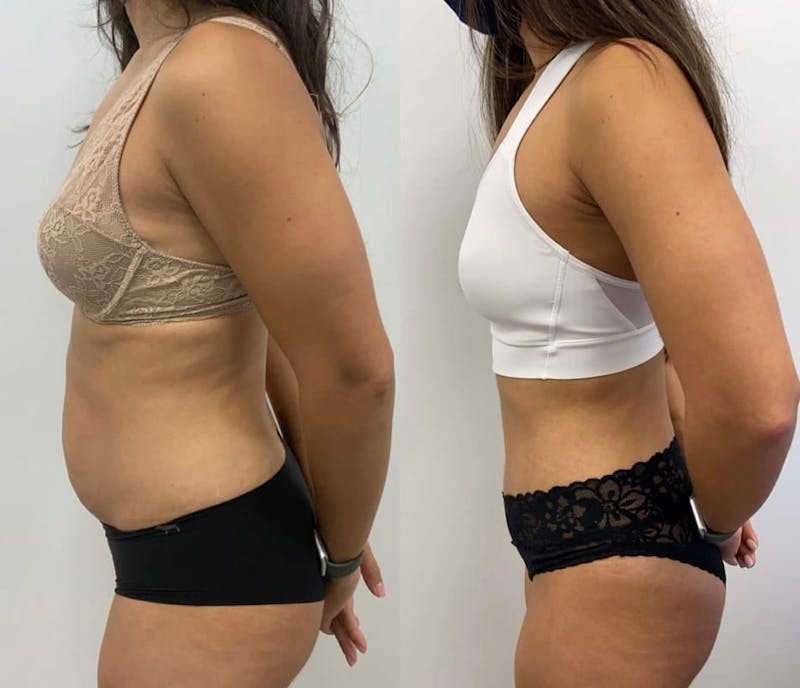 Tummy Tuck Before & After Gallery - Patient 204213 - Image 1