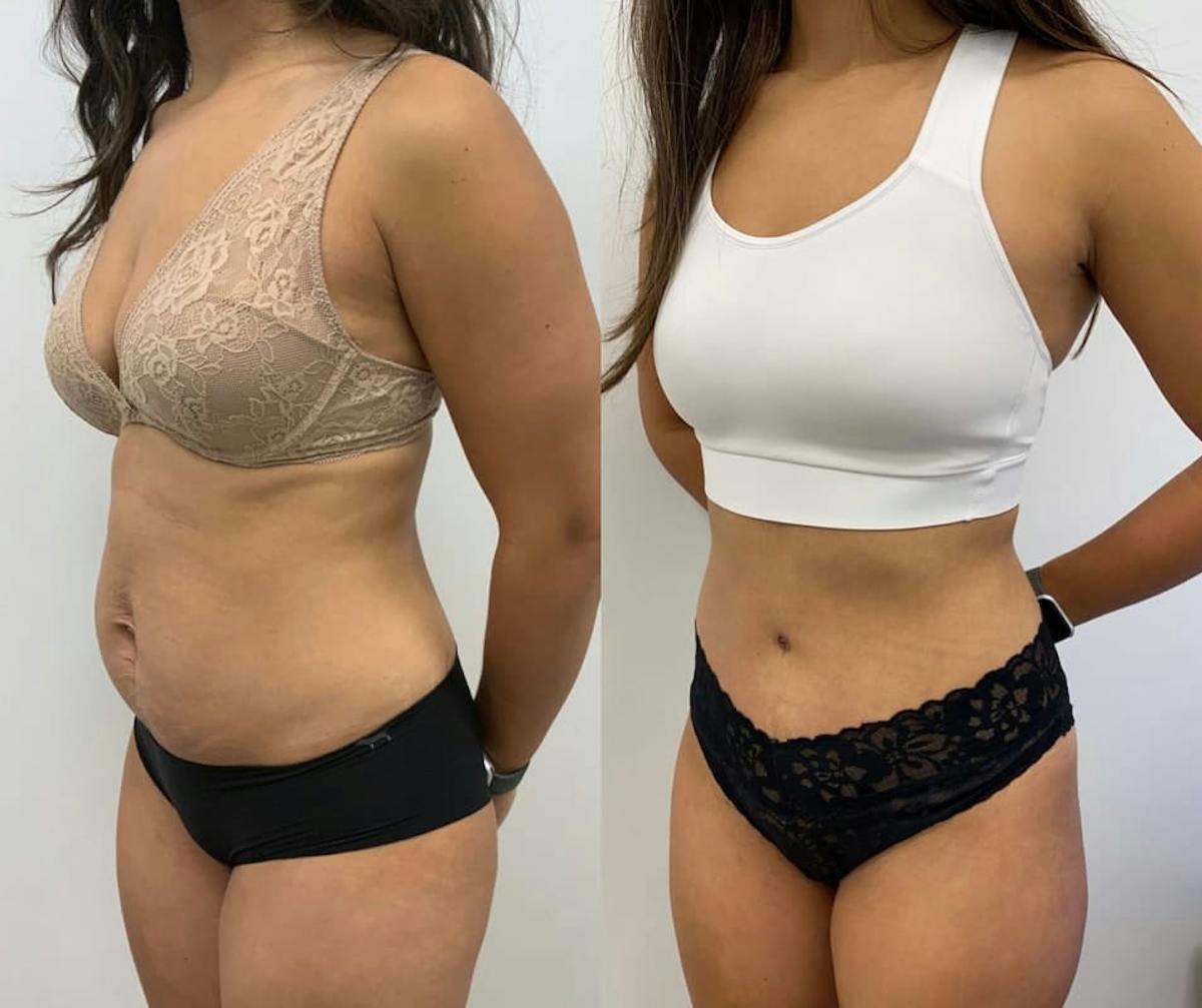 Tummy Tuck Before & After Gallery - Patient 204213 - Image 2
