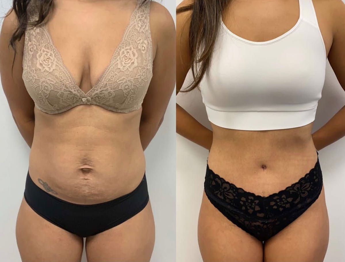 Tummy Tuck Before & After Gallery - Patient 204213 - Image 3