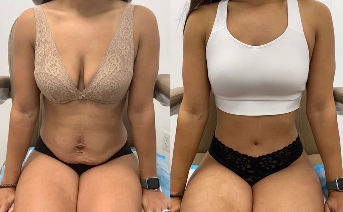 Tummy Tuck Before & After Gallery - Patient 204213 - Image 4