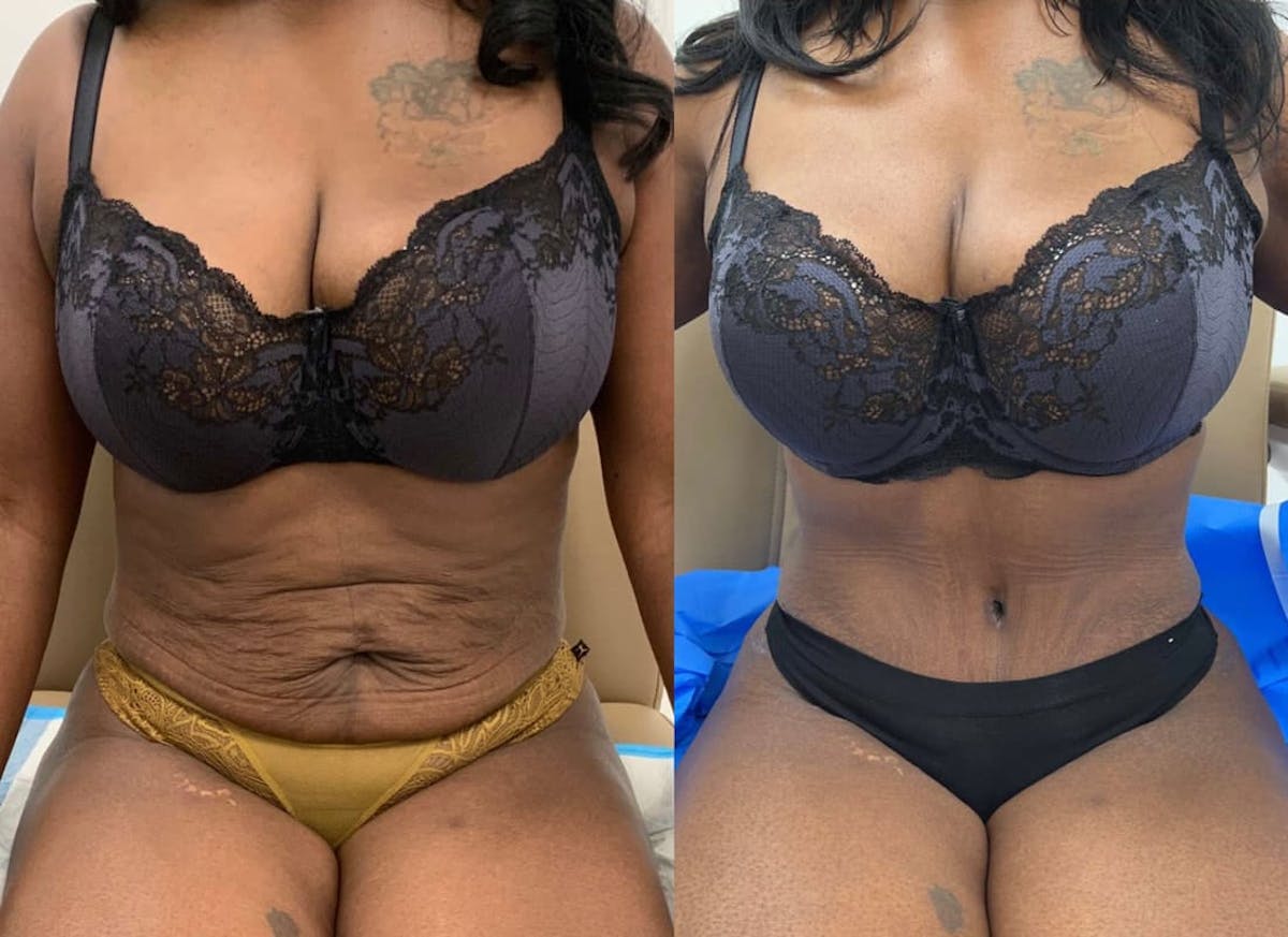 Tummy Tuck Before & After Gallery - Patient 252908 - Image 1