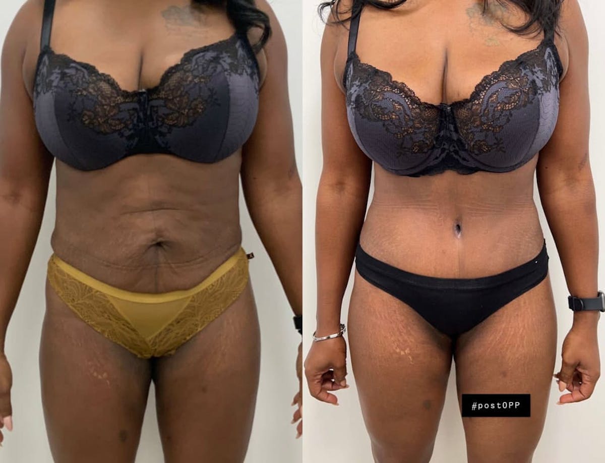 Tummy Tuck Before & After Gallery - Patient 252908 - Image 2