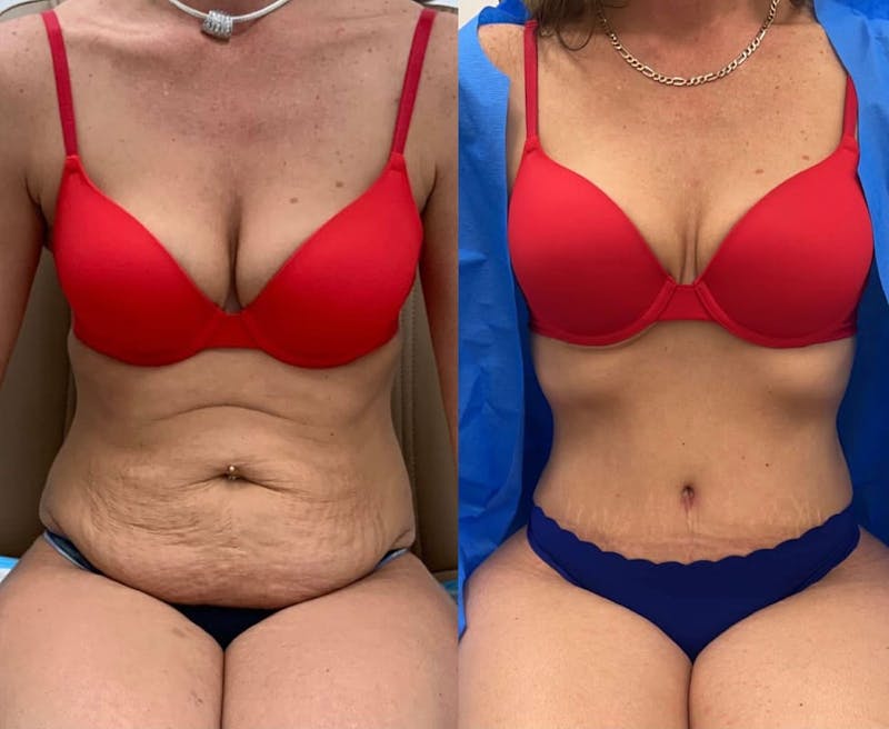 Tummy Tuck Before & After Gallery - Patient 150637 - Image 1