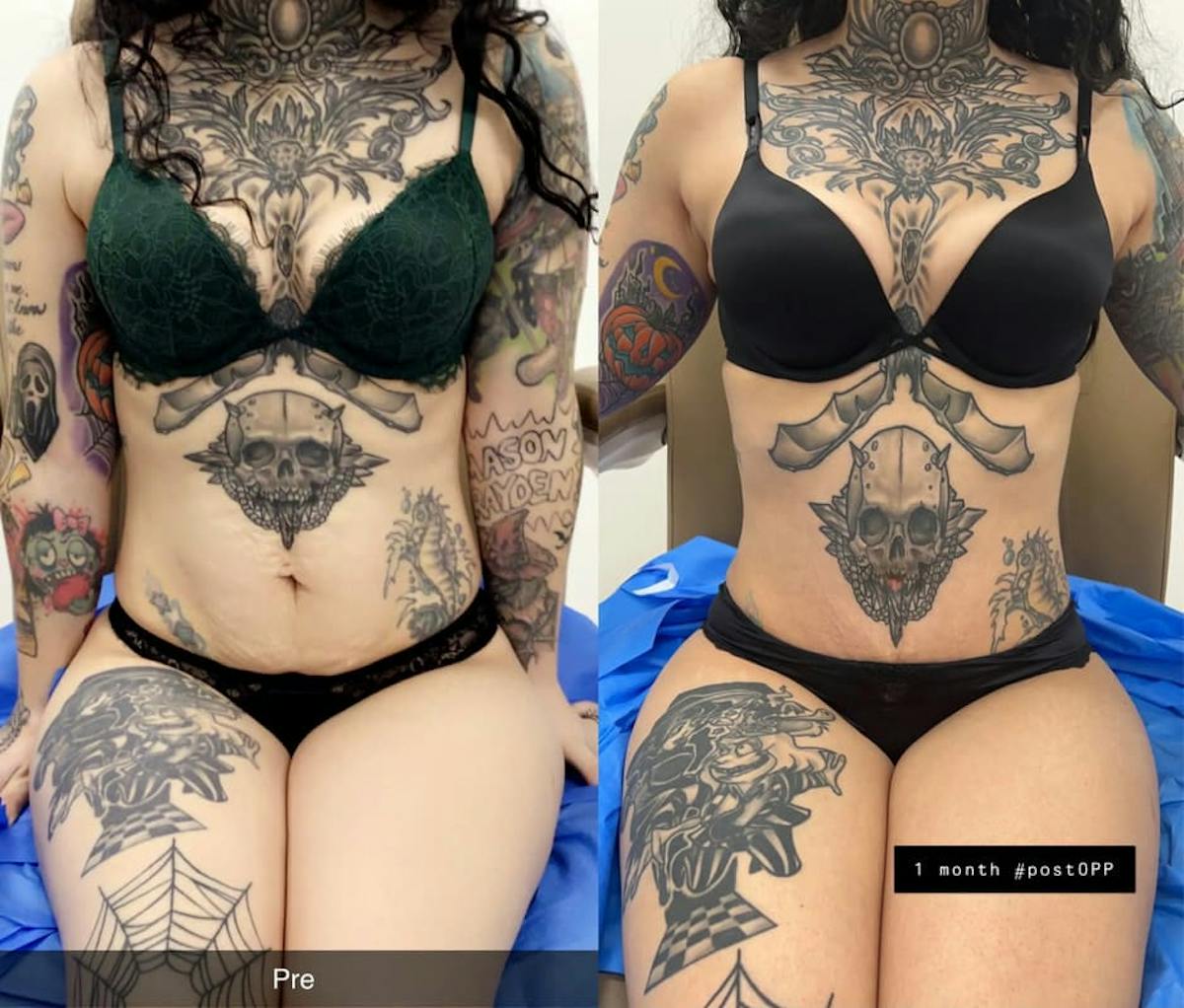 Tummy Tuck Before & After Gallery - Patient 370202 - Image 1