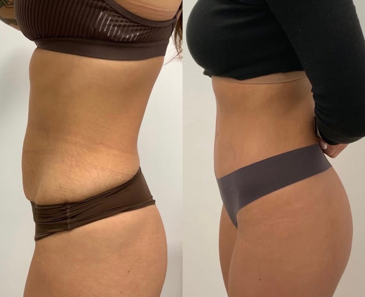 Tummy Tuck Before & After Gallery - Patient 355930 - Image 1