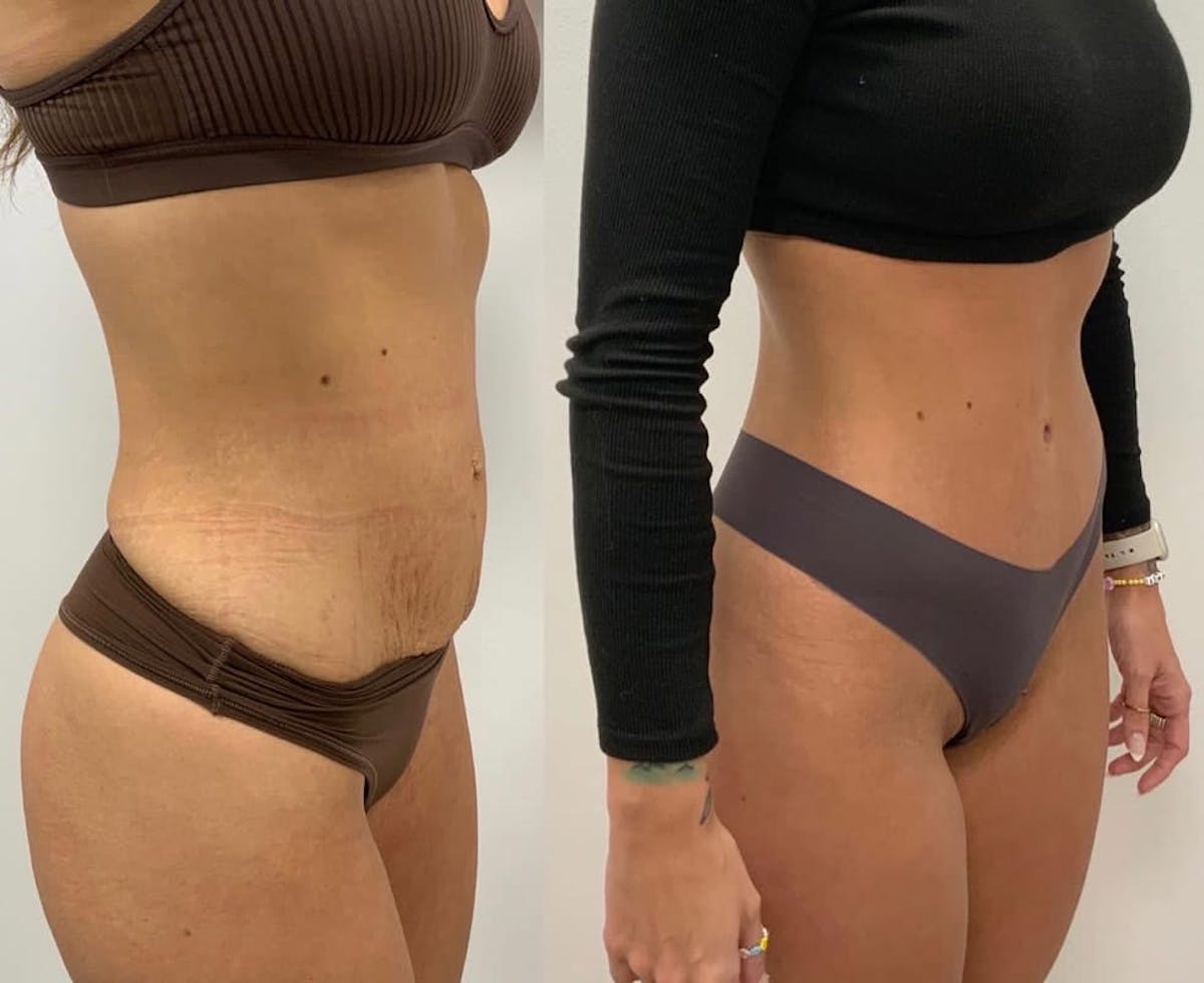 Tummy Tuck Before & After Gallery - Patient 355930 - Image 2