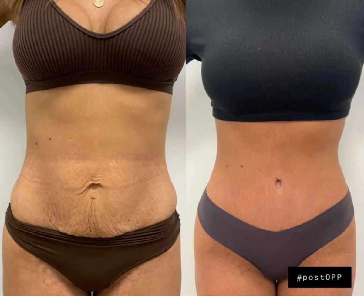 Tummy Tuck Before & After Gallery - Patient 355930 - Image 3