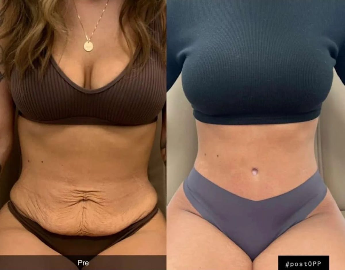 Tummy Tuck Before & After Gallery - Patient 355930 - Image 4