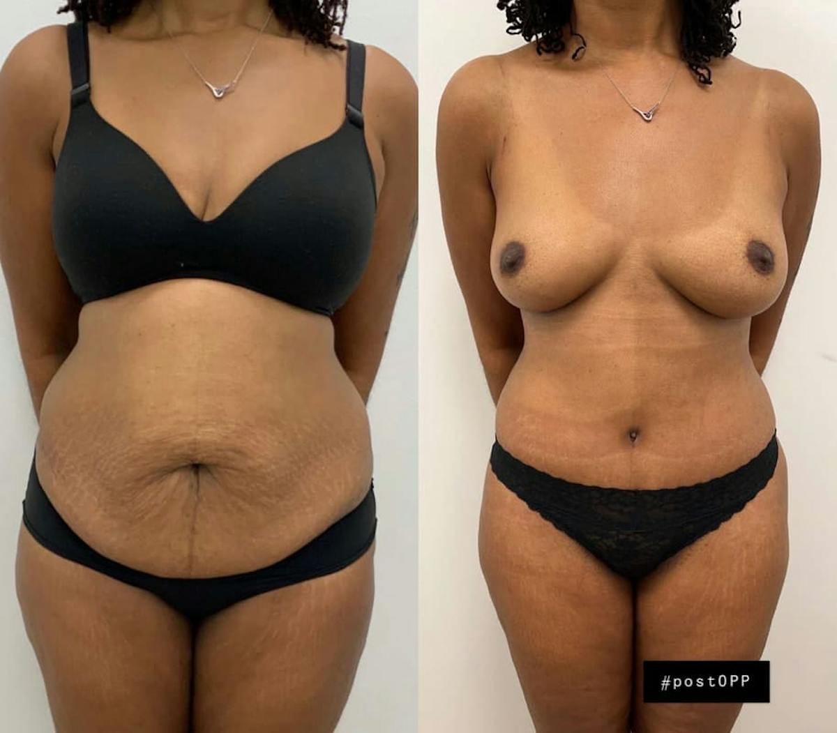 Tummy Tuck Before & After Gallery - Patient 390756 - Image 1