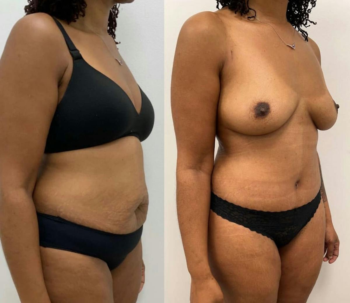 Tummy Tuck Before & After Gallery - Patient 390756 - Image 2