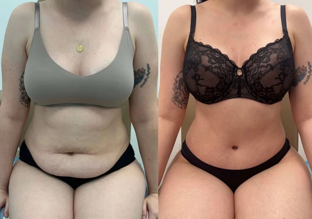 Tummy Tuck Before & After Gallery - Patient 408655 - Image 1