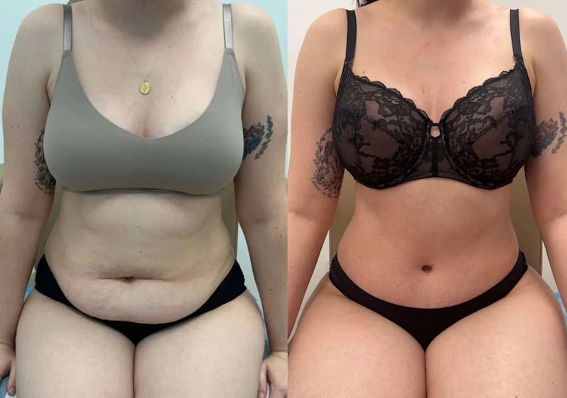 Tummy Tuck Before & After Gallery - Patient 408655 - Image 1