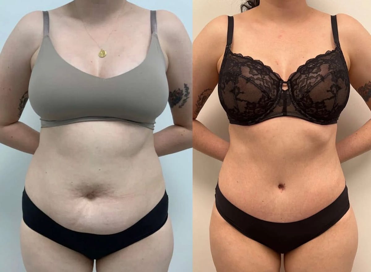 Tummy Tuck Before & After Gallery - Patient 408655 - Image 2