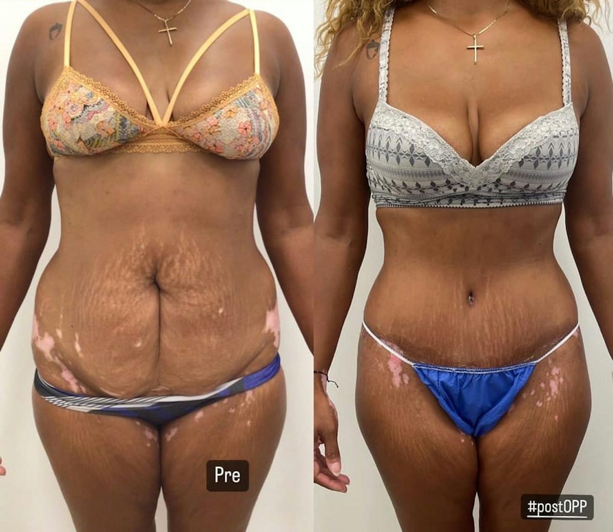 Tummy Tuck Before & After Gallery - Patient 395512 - Image 1