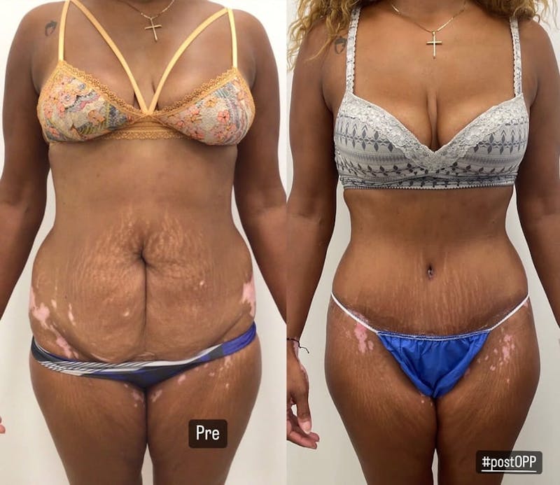 Tummy Tuck Before & After Gallery - Patient 395512 - Image 1