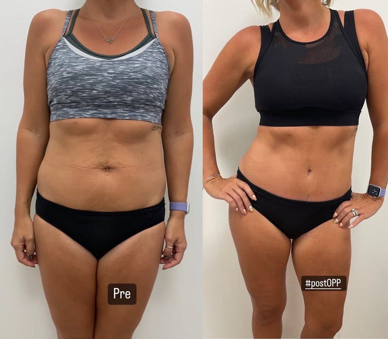 Tummy Tuck Before & After Gallery - Patient 434093 - Image 1