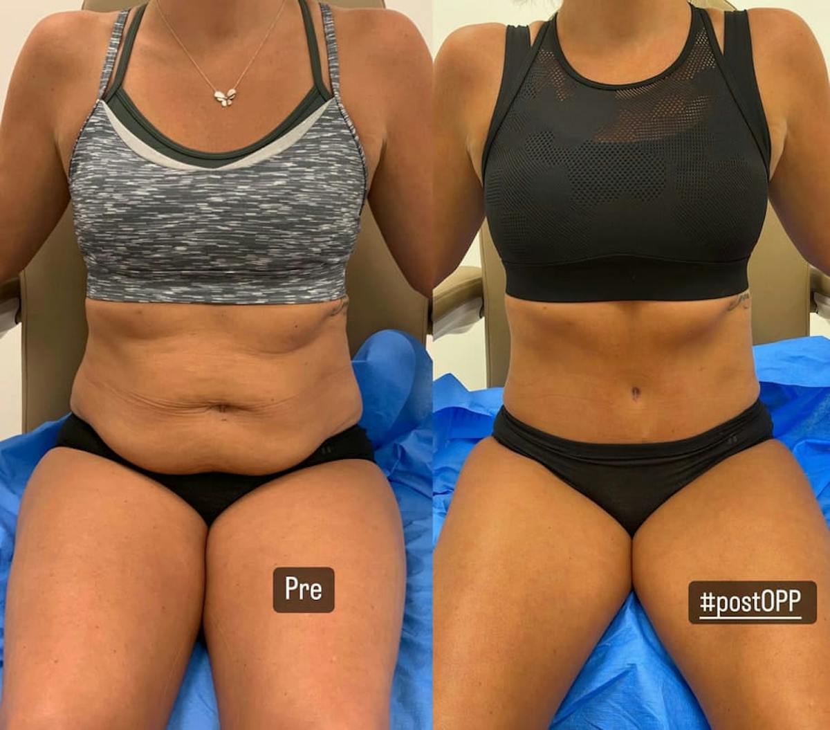 Tummy Tuck Before & After Gallery - Patient 434093 - Image 2