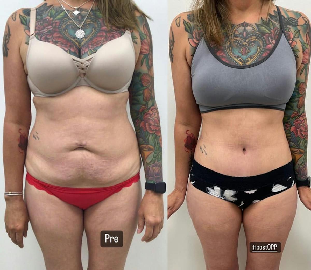 Tummy Tuck Before & After Gallery - Patient 150863 - Image 1