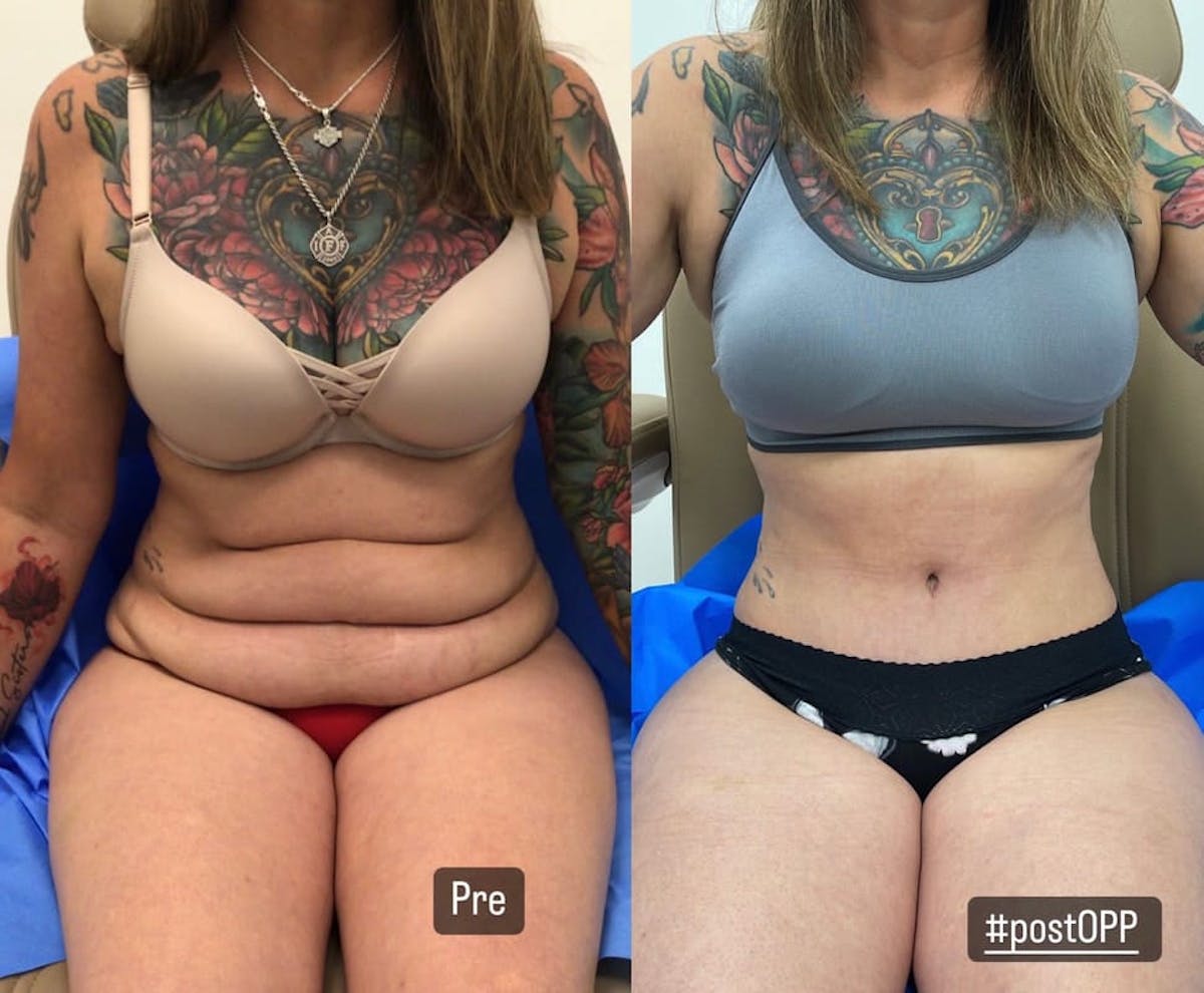 Tummy Tuck Before & After Gallery - Patient 150863 - Image 2