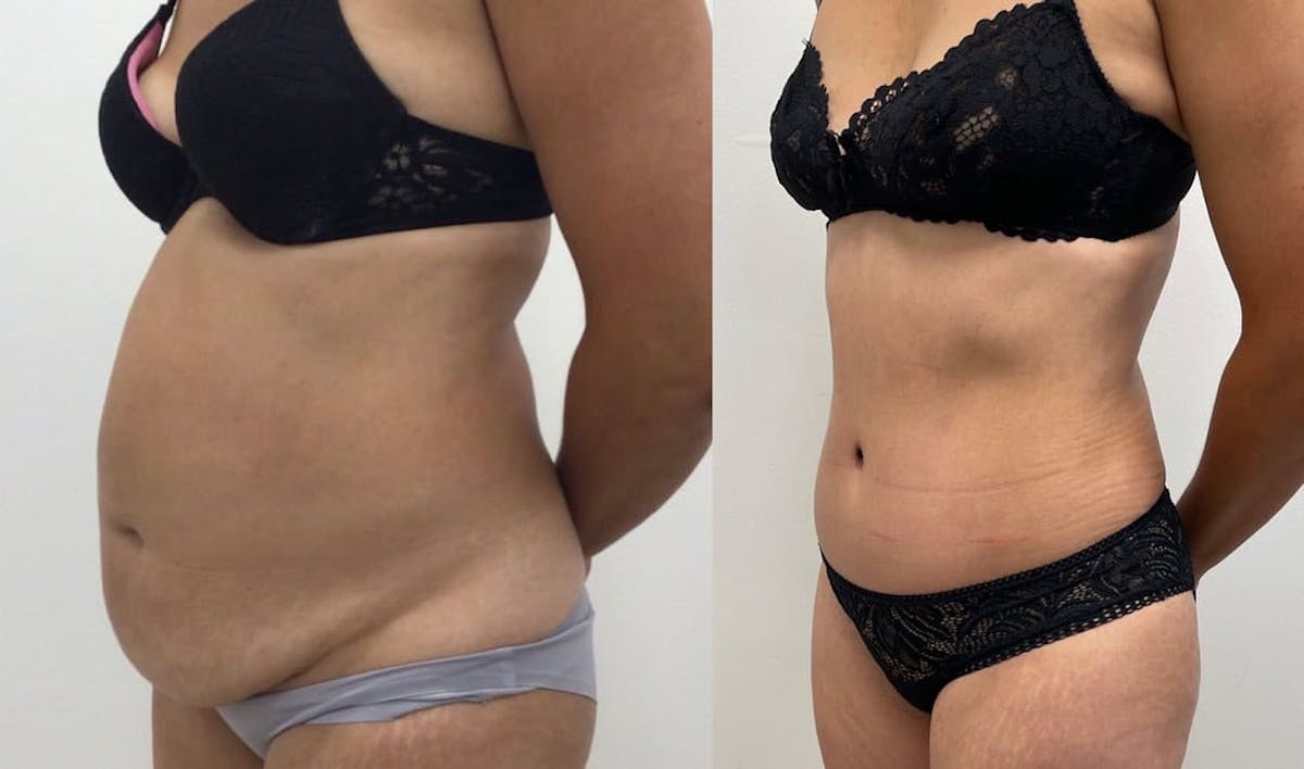 Tummy Tuck Before & After Gallery - Patient 136765 - Image 1