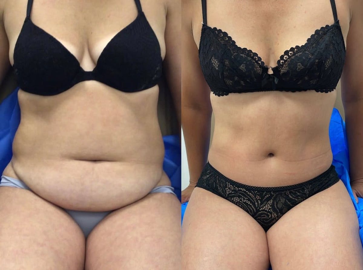 Tummy Tuck Before & After Gallery - Patient 136765 - Image 3