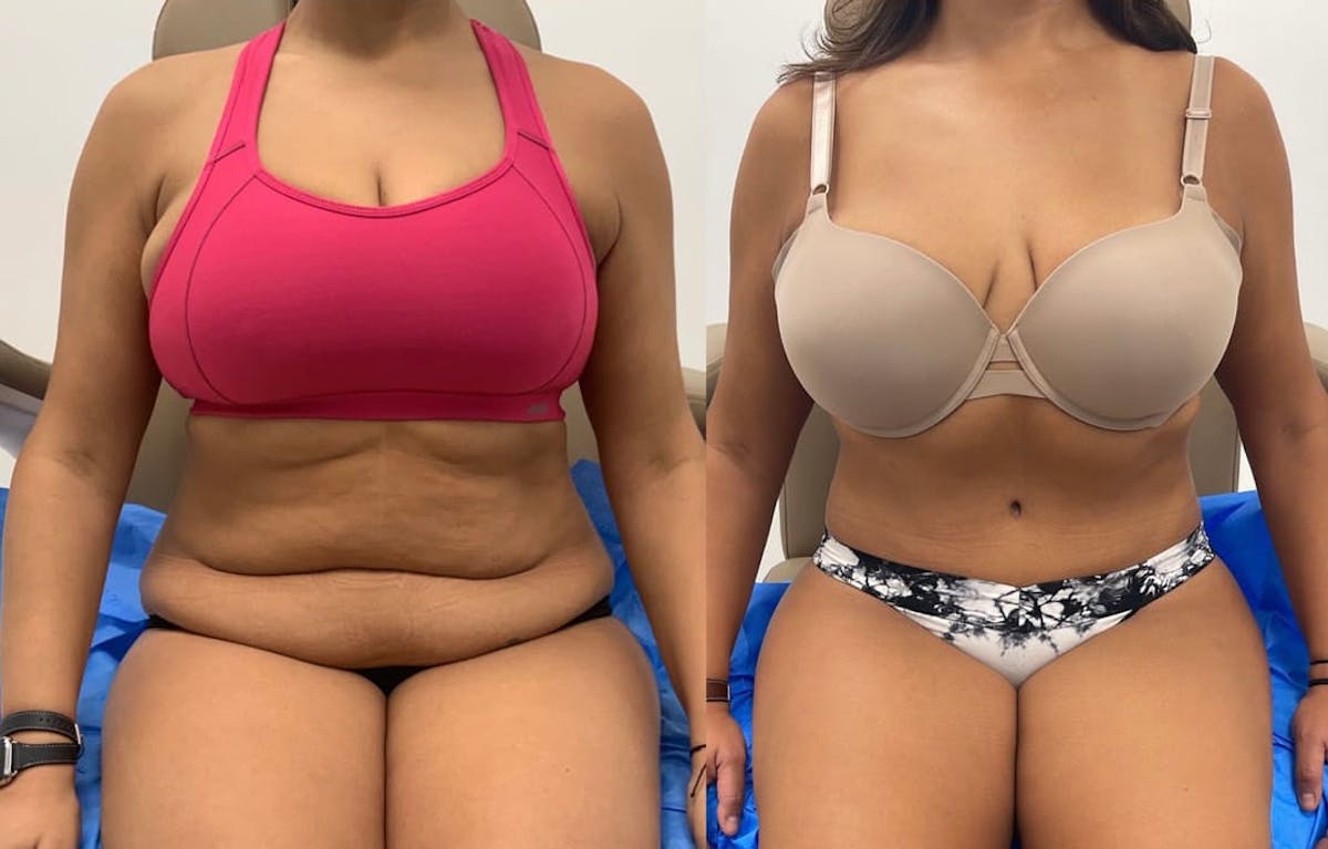 Tummy Tuck Before & After Gallery - Patient 258067 - Image 1