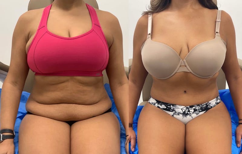 Tummy Tuck Before & After Gallery - Patient 258067 - Image 1