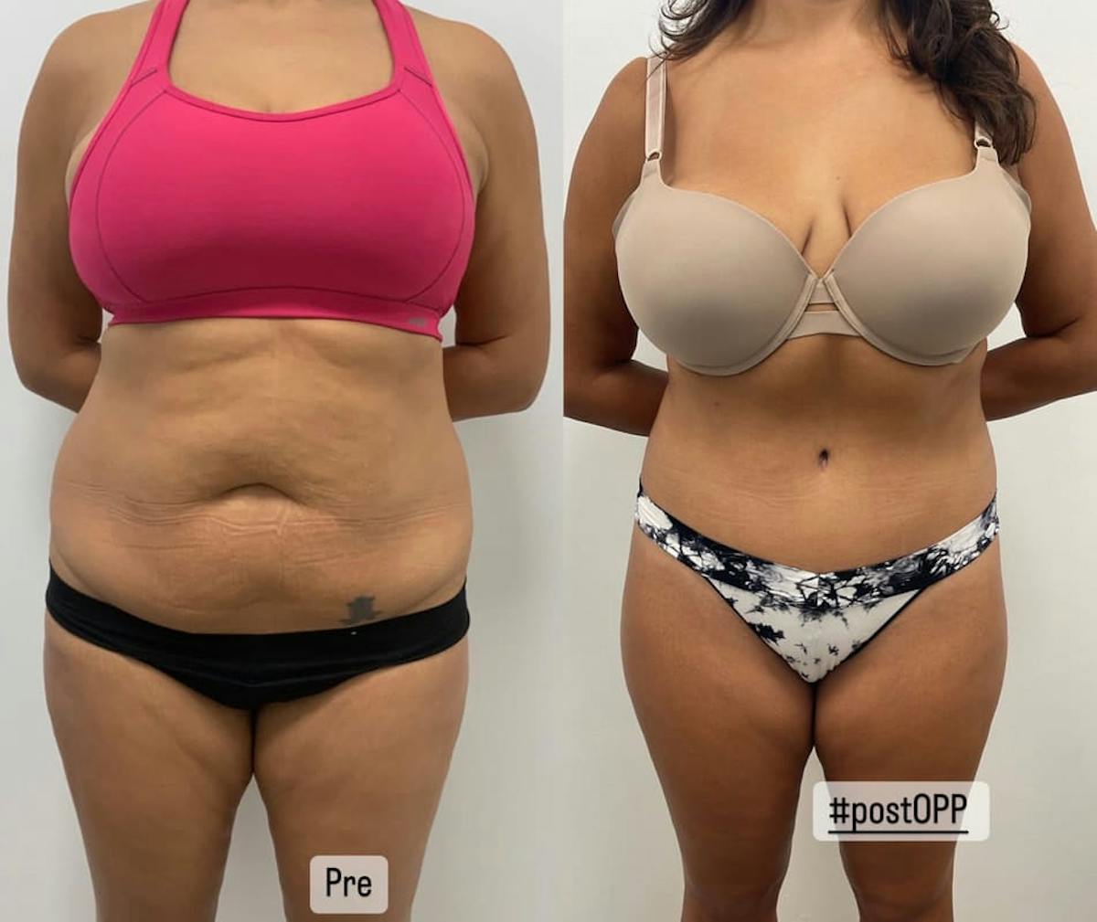Tummy Tuck Before & After Gallery - Patient 258067 - Image 2