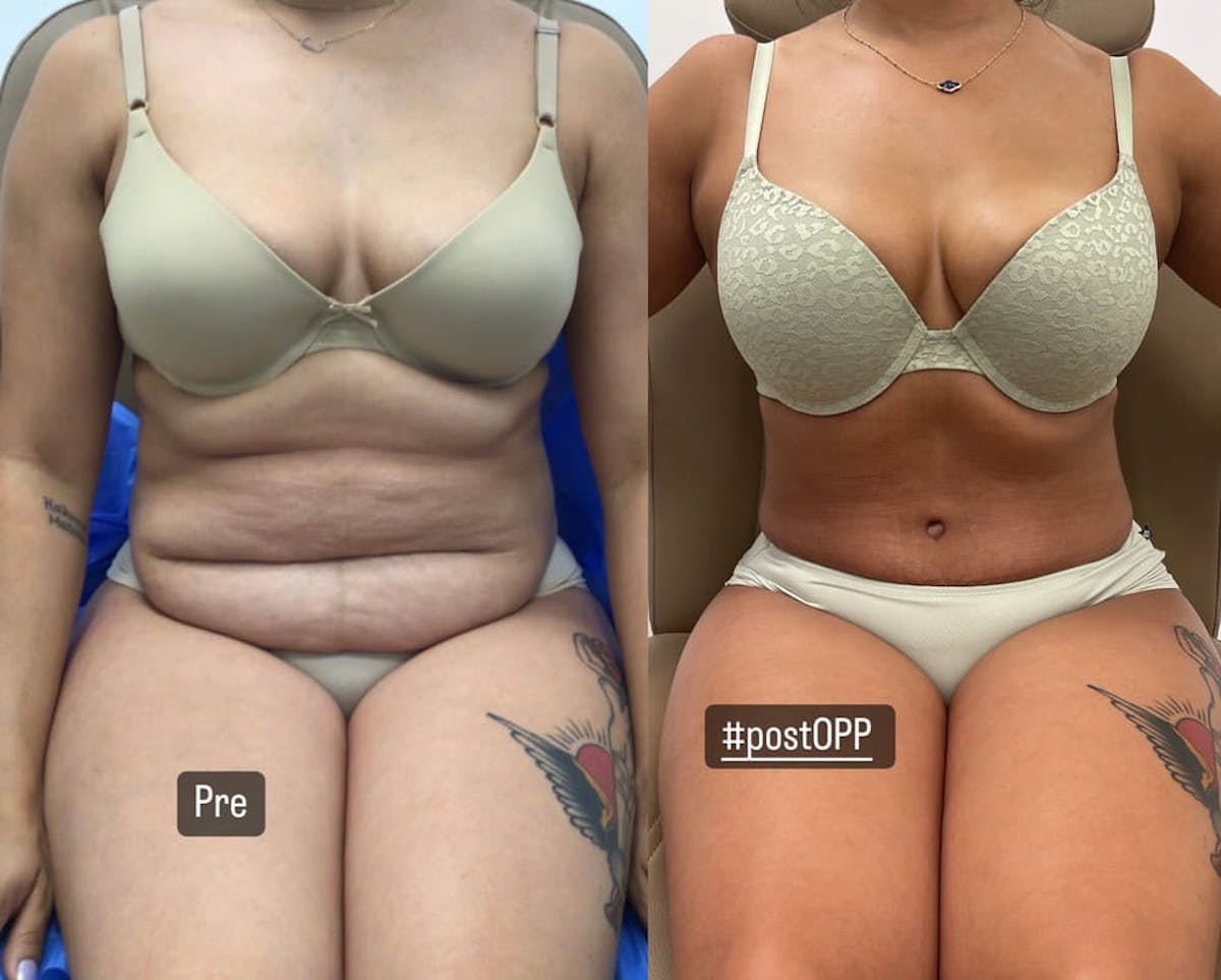 Tummy Tuck Before & After Gallery - Patient 318278 - Image 1