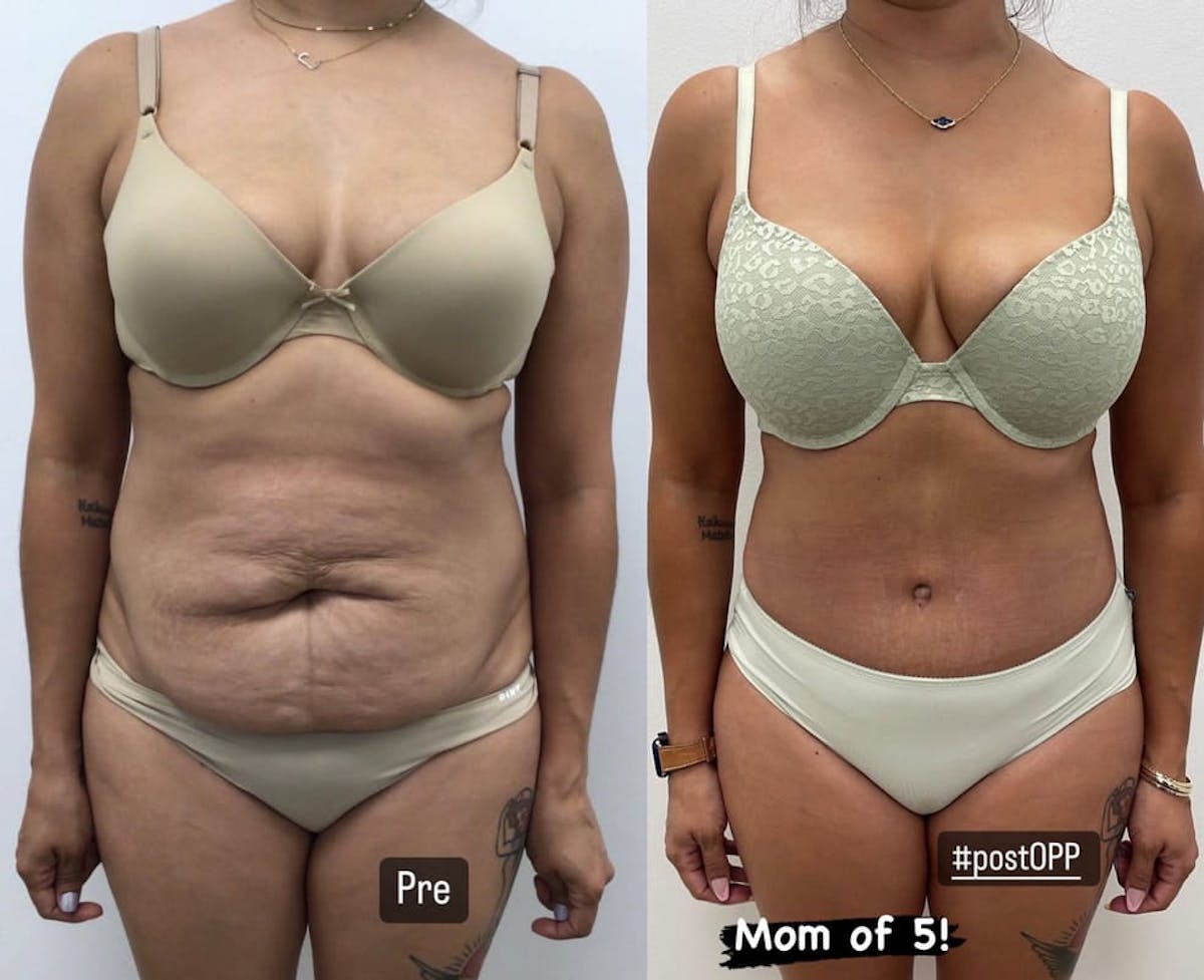 Tummy Tuck Before & After Gallery - Patient 318278 - Image 2