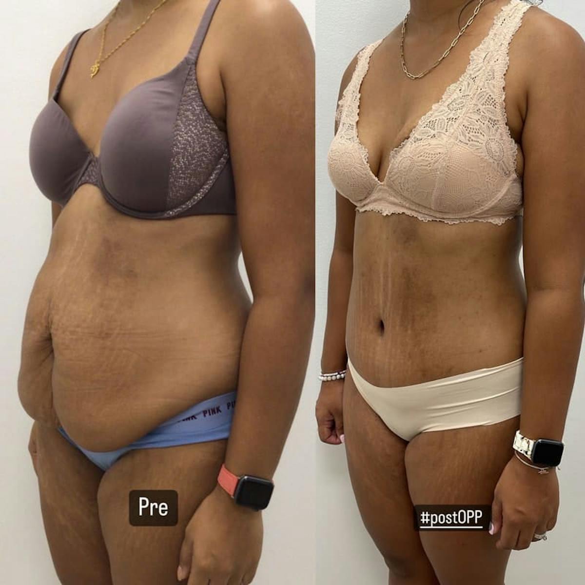Tummy Tuck Before & After Gallery - Patient 419472 - Image 1