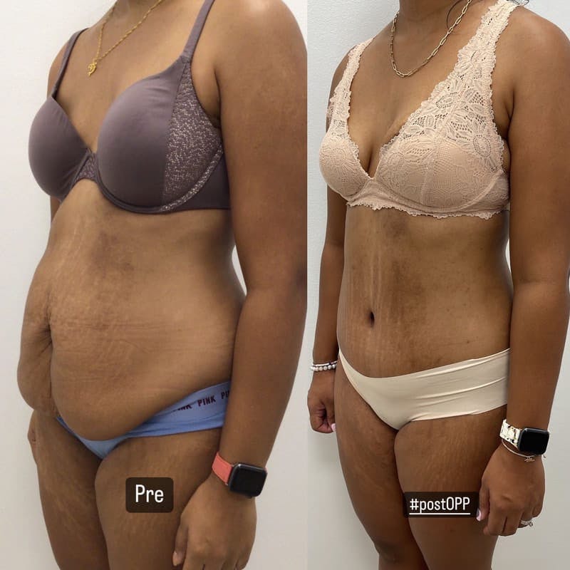 Tummy Tuck Before & After Gallery - Patient 419472 - Image 1
