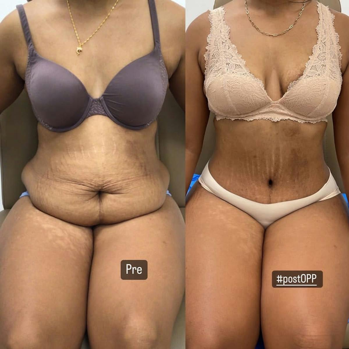 Tummy Tuck Before & After Gallery - Patient 419472 - Image 2