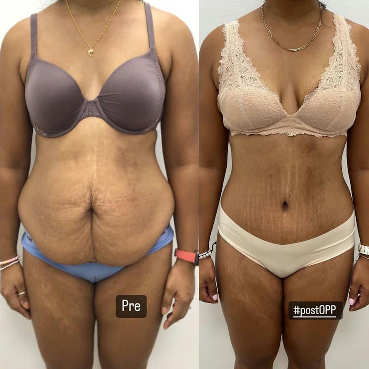 Tummy Tuck Before & After Gallery - Patient 419472 - Image 3