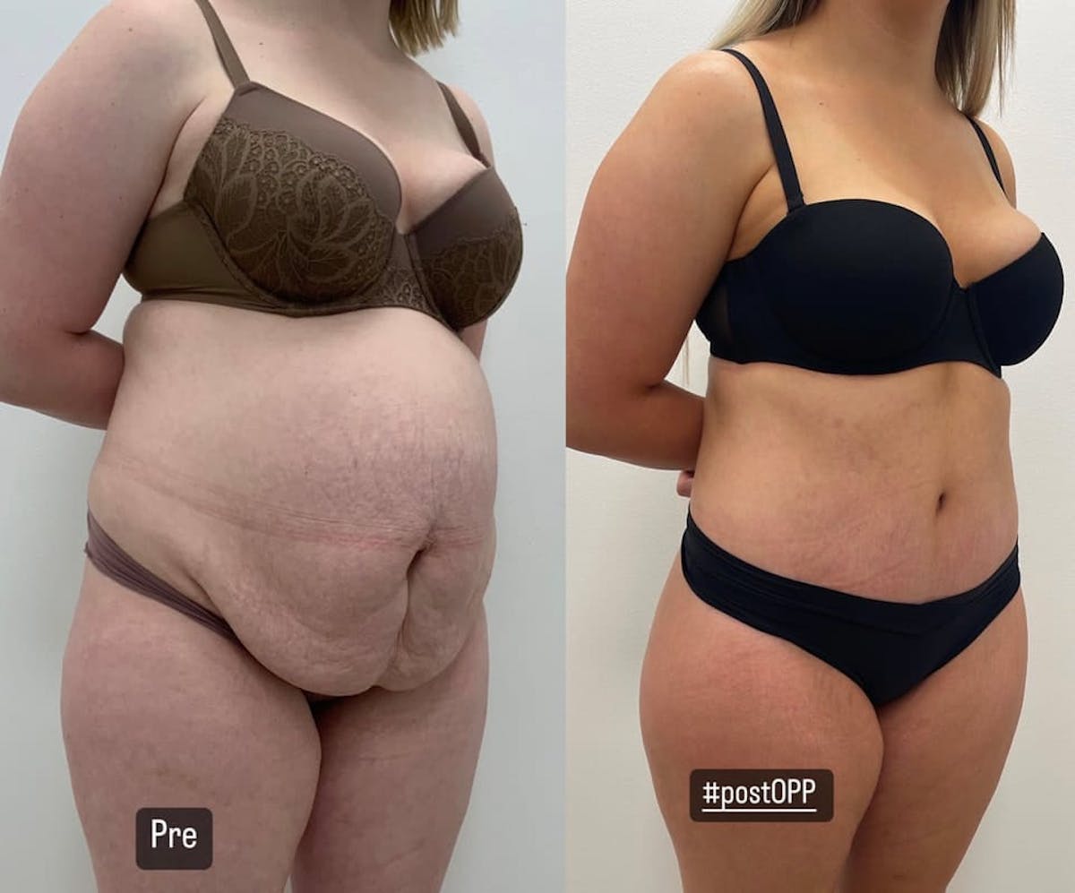 Tummy Tuck Before & After Gallery - Patient 196984 - Image 1