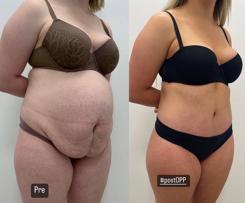 Tummy Tuck Before & After Gallery - Patient 196984 - Image 1
