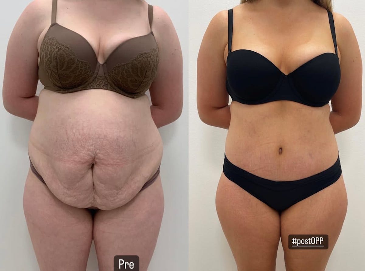 Tummy Tuck Before & After Gallery - Patient 196984 - Image 2