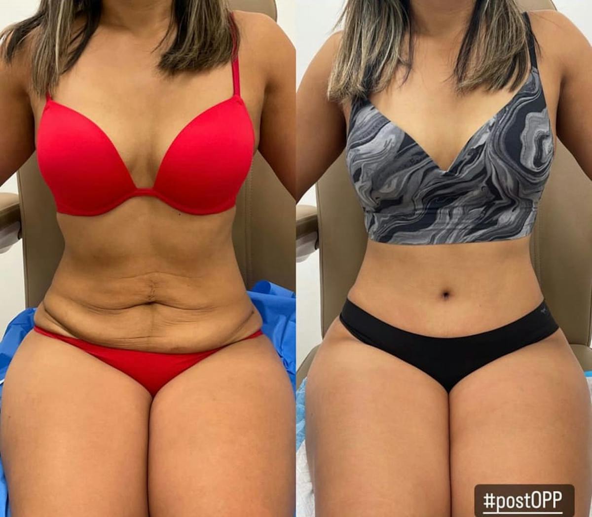 Tummy Tuck Before & After Gallery - Patient 396701 - Image 1