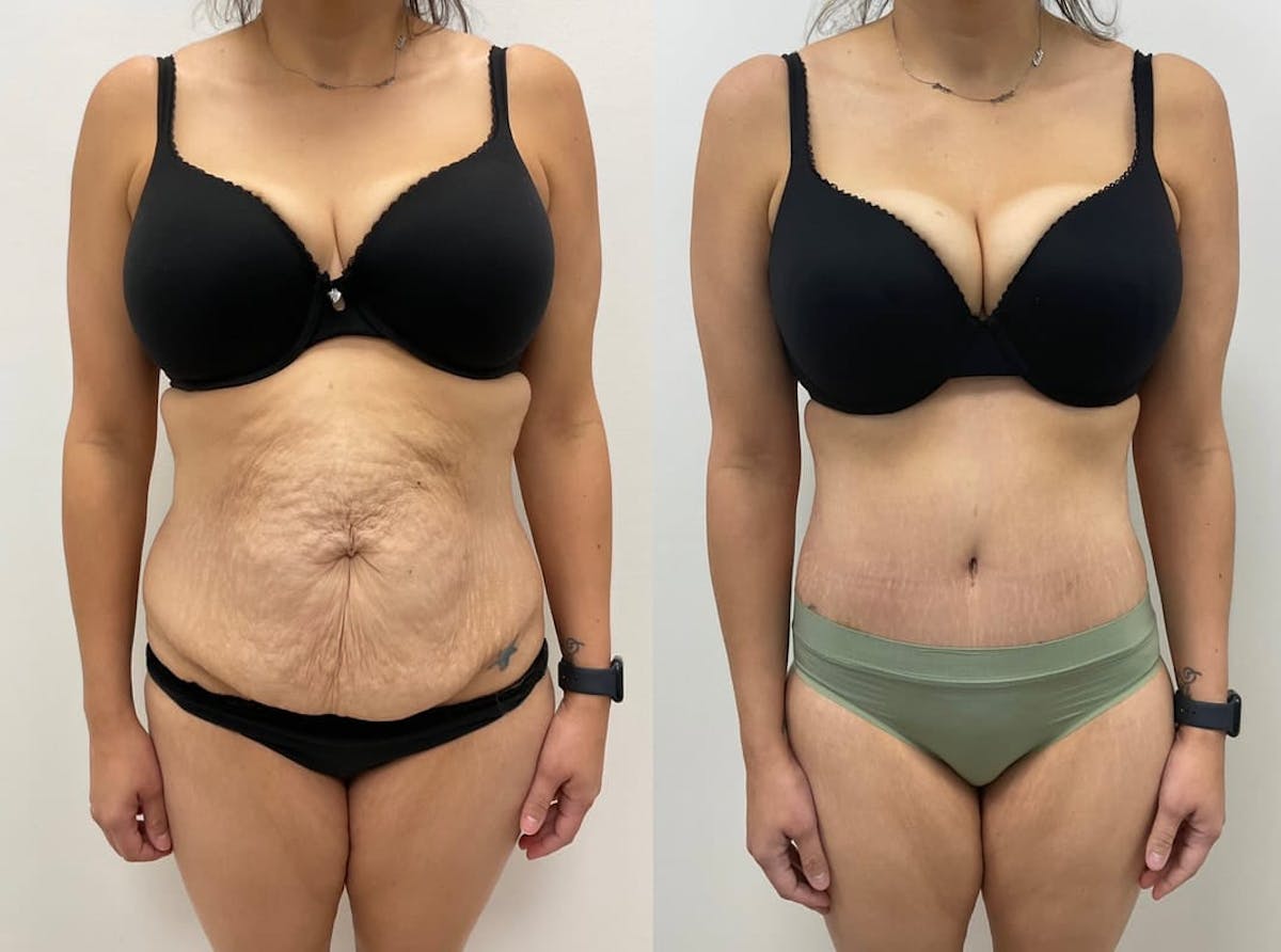 Tummy Tuck Before & After Gallery - Patient 219613 - Image 1