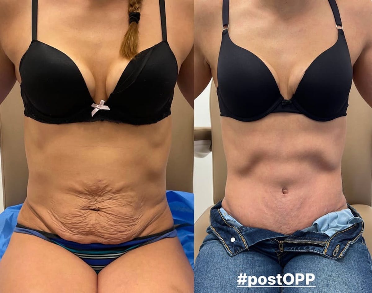 Tummy Tuck Before & After Gallery - Patient 208429 - Image 1