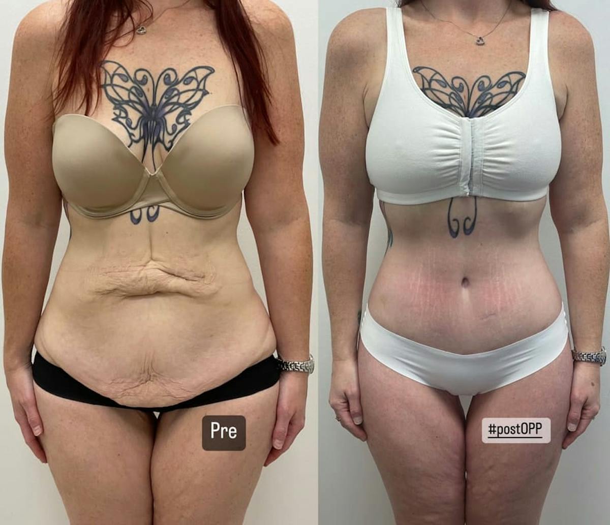 Tummy Tuck Before & After Gallery - Patient 872866 - Image 1