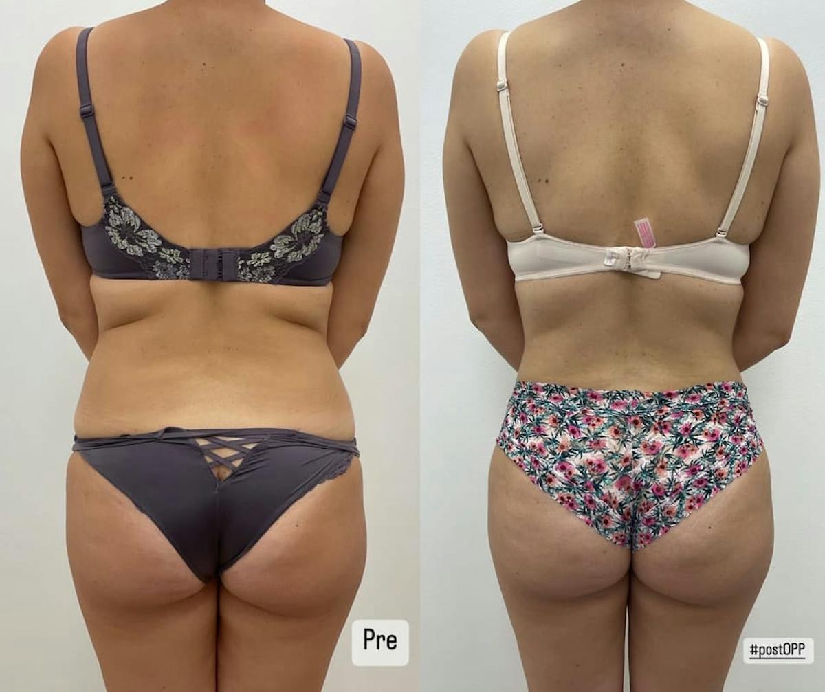 Tummy Tuck Before & After Gallery - Patient 346381 - Image 1