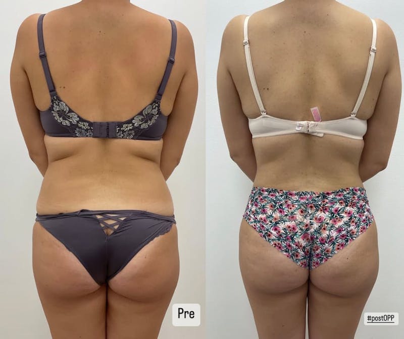Tummy Tuck Before & After Gallery - Patient 346381 - Image 1