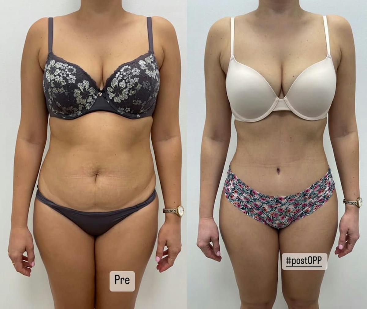 Tummy Tuck Before & After Gallery - Patient 346381 - Image 2