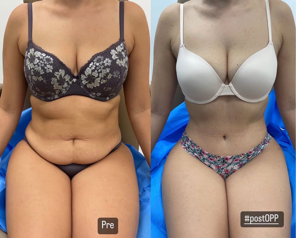 Tummy Tuck Before & After Gallery - Patient 346381 - Image 3
