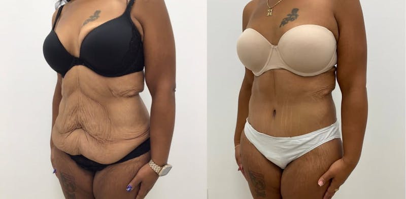 Tummy Tuck Before & After Gallery - Patient 229227 - Image 1