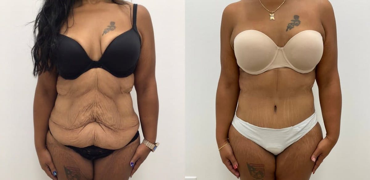 Tummy Tuck Before & After Gallery - Patient 229227 - Image 2